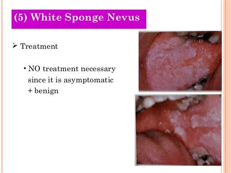 Leukoedema Vs Leukoplakia / Gingivitis - How You Can Prevent It ...