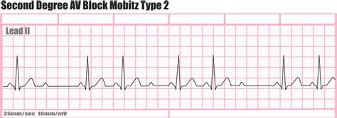 Heart block causes, symptoms, types, diagnosis and heart block treatment