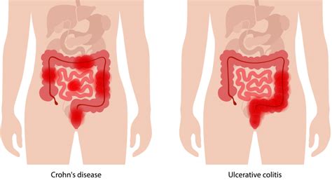 What to Know About Crohn’s Disease and Colitis