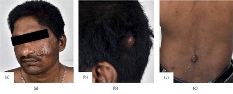 Angiolymphoid Hyperplasia with Eosinophilia In 40-Year-Old