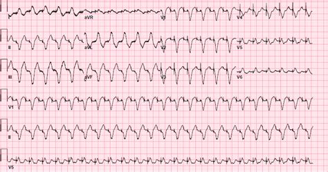 Cureus | Pacemaker-Mediated Tachycardia: A Case Report