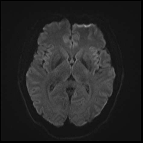 Glioblastoma - early | Image | Radiopaedia.org