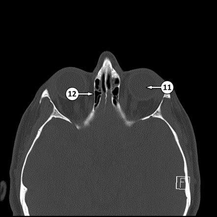 Lamina papyracea | Radiology Reference Article | Radiopaedia.org