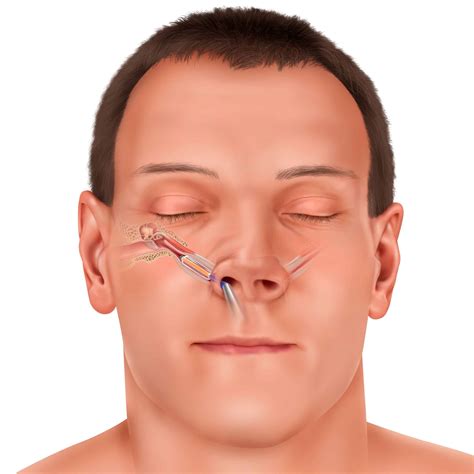 How To Use Nasal Spray For Eustachian Tube - Quotes Viral