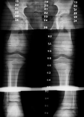 Hemihypertrophy - Pediatrics - Orthobullets