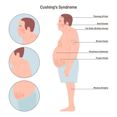 Is Cushing Syndrome Fatal? Find Out More...