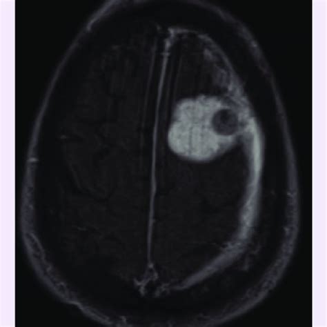 Axial T1 contrast-enhanced MRI. An axial T1 contrast-enhanced MRI image... | Download Scientific ...