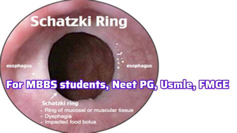 Schatzki Ring For MBBS students, Neet PG, Usmle, FMGE I Neet PG Usmle ...