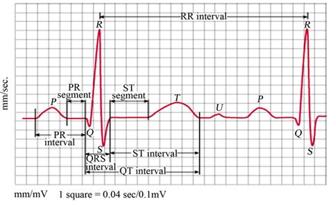 Wavelet diagnosis of ECG signals with kaiser based noise diminution