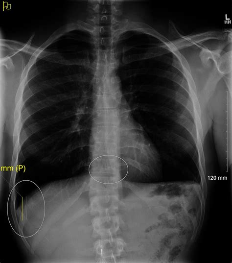 Migration of a fractured inferior vena cava filter strut to the right ventricle of the heart ...