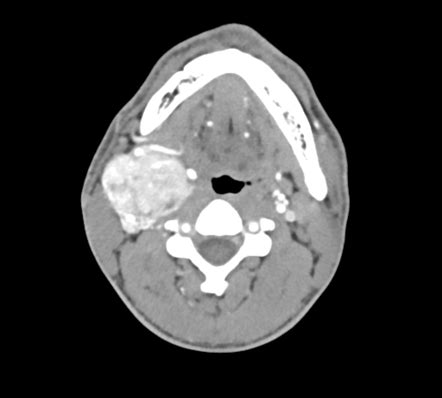 Carotid body tumour | Radiology Case | Radiopaedia.org