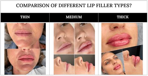 Difference between 1ml of thin, med and thick lip filler?