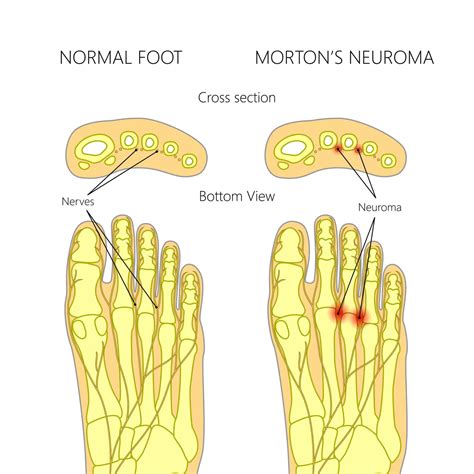 Morton's Neuroma Surgery: Learn everything about it and recovery