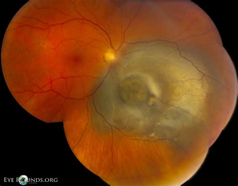 Choroidal malignant melanoma in a "collar button" configuration: Online Atlas of Ophthalmology ...