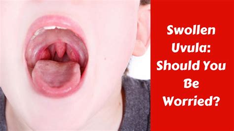 Swollen Uvula - Should you be worried? - YouTube