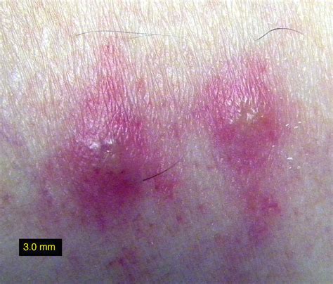 Chiggers (Mite) Bites, Rash Pictures, Treatment, Eradication | Healthhype.com