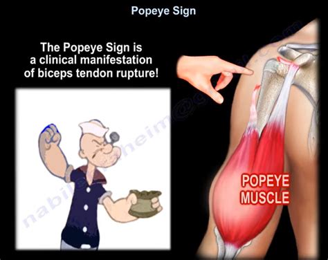 Proximal Biceps Tendon Rupture — OrthopaedicPrinciples.com