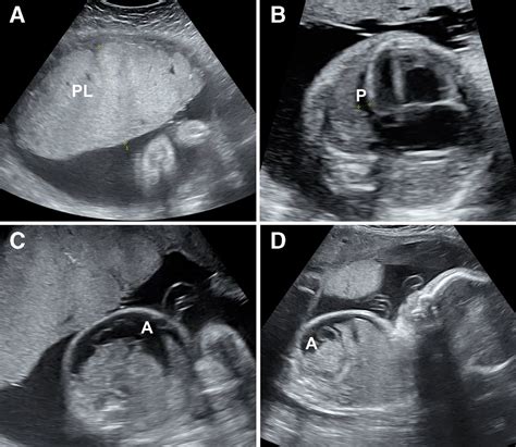 Hydrops Ultrasound