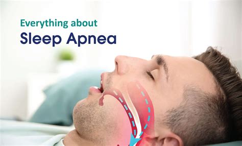 Sleep Apnea: What it is, types, symptoms, and its treatment