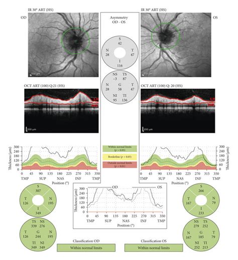 Optic nerve head optical coherence tomography showing significant optic... | Download Scientific ...