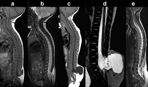 False Chiari I malformation in lipomyelomeningocele. a, b Spinal MRI... | Download Scientific ...