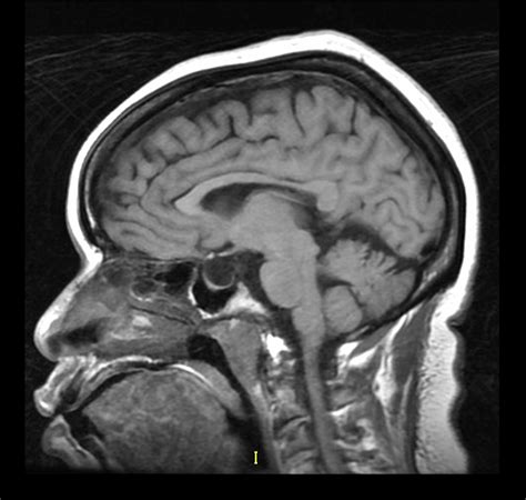 Macroglossia: A Potentially Severe Sign of Pompe Disease