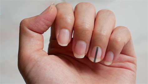 Woman’s Warning Goes Viral After Finding out Curved Fingernails Are a ...