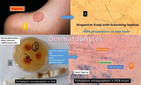 Dermatophytes: Introduction, Infection and its Laboratory Diagnosis