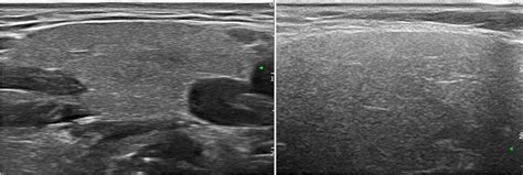 Normal Submandibular Gland Ultrasound