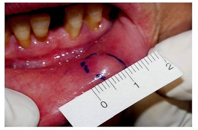 Healthy Ranula: Notes on Mucocele and Mucous Retention cyst-Etiology ...