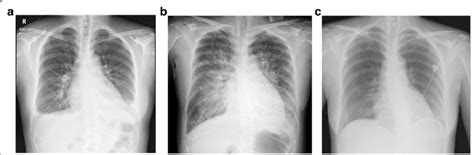 Chest Radiography The Chest Radiograph Shows Bilateral Pleural | Images and Photos finder