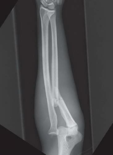 Monteggia Fracture | Radiology Key