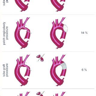 Various techniques for surgical repair of aortic coarctation ...