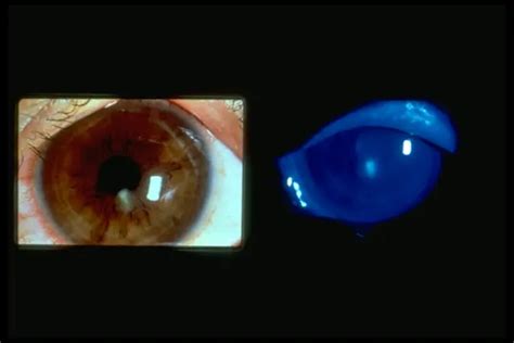 Corneal infiltrate and epithelial defect - American Academy of ...