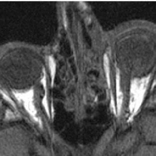 Optic nerve avulsion injury with posterior dislocation of lamina ...