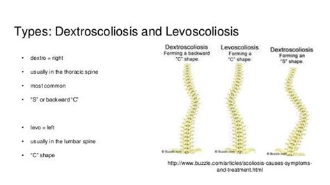 Image result for lumbar dextro scoliosis | Lumbar, Streching, Scoliosis