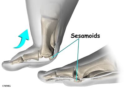 Sesamoid Problems - Orthopedic Surgery, Algonquin, IL, Barrington, IL ...