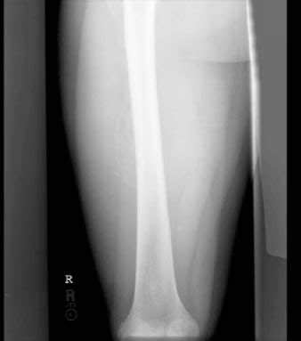 Russell's Blog: myositis ossificans histology