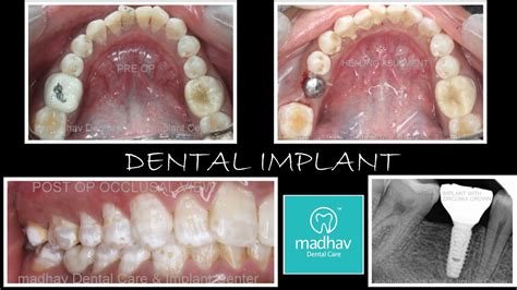 Single Tooth Implant – Madhav Dental Clinic