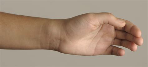 An unusual case of traumatic wrist swelling | Archives of Disease in Childhood