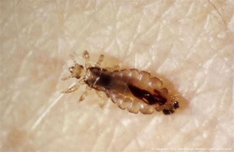 Head Lice Facts | Health And Beauty