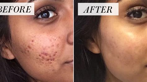 Controversial Cystic Acne Routine Goes Viral — Before-and-After Photos ...