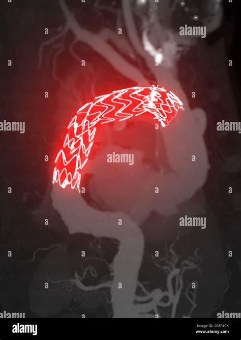 CTA whole aorta with thoracic aorta stent graft 3D rendering image in case abdominal aortic ...