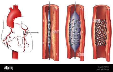 Coronary stent hi-res stock photography and images - Alamy