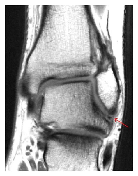 Coronal T1-weighted MR image showing an ATFL tear (arrow). | Download ...