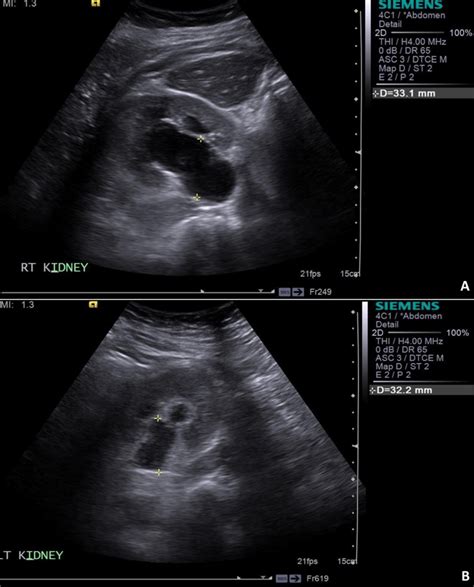 Ultrasound of renal tract A -Right renal pelvis measuring 33mm in AP... | Download Scientific ...