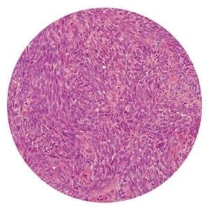 Types of Mesothelioma Cancer Based on Cell, Location & Rarity