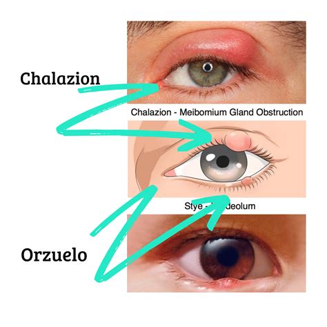 Orzuelo y Chalazion • Soy tu Farmacia de Guardia