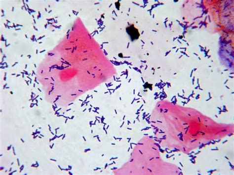 Fun With Microbiology (What's Buggin' You?): Bacterial Vaginosis