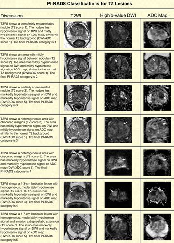 RadioGraphics Update: PI-RADS Version 2.1—A Pictorial Update | RadioGraphics